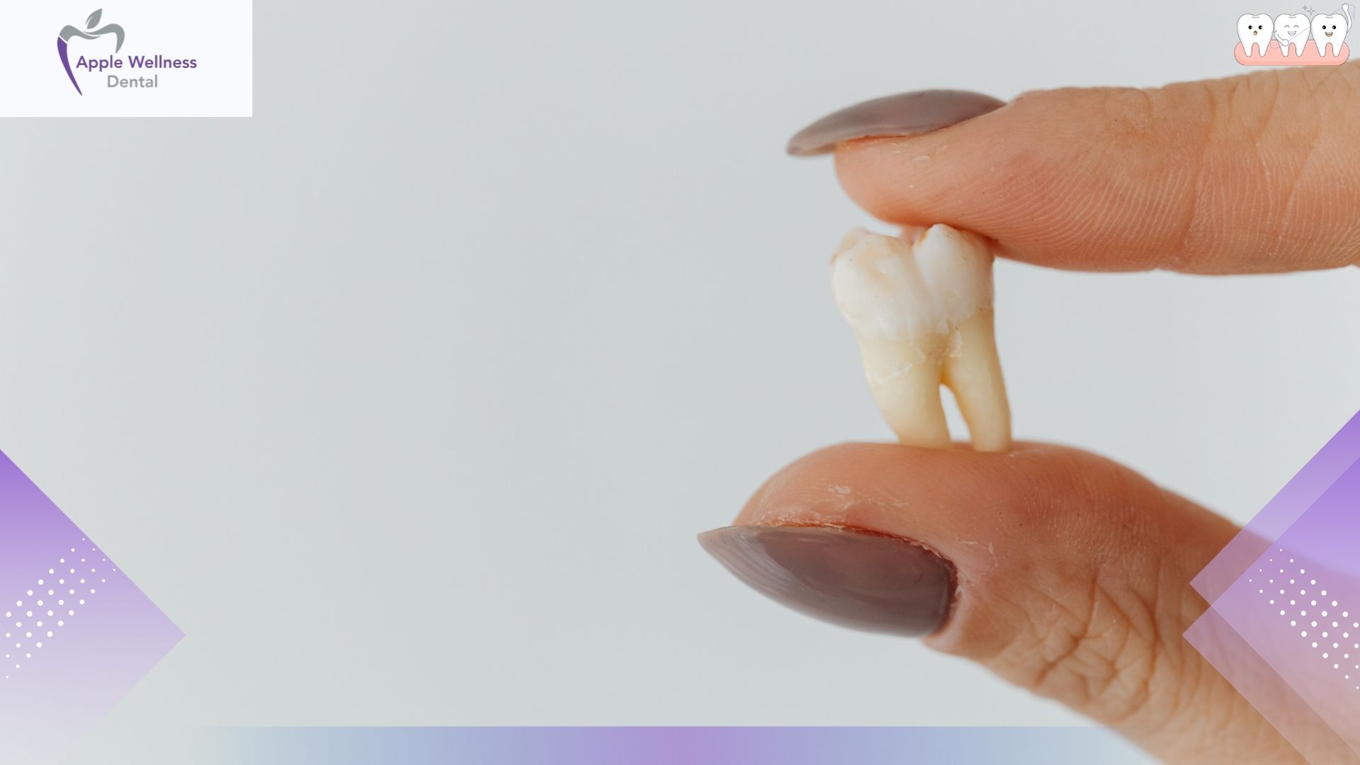 How Long Should I Take Painkillers After Wisdom Tooth Extraction? - Apple Wellness Dental