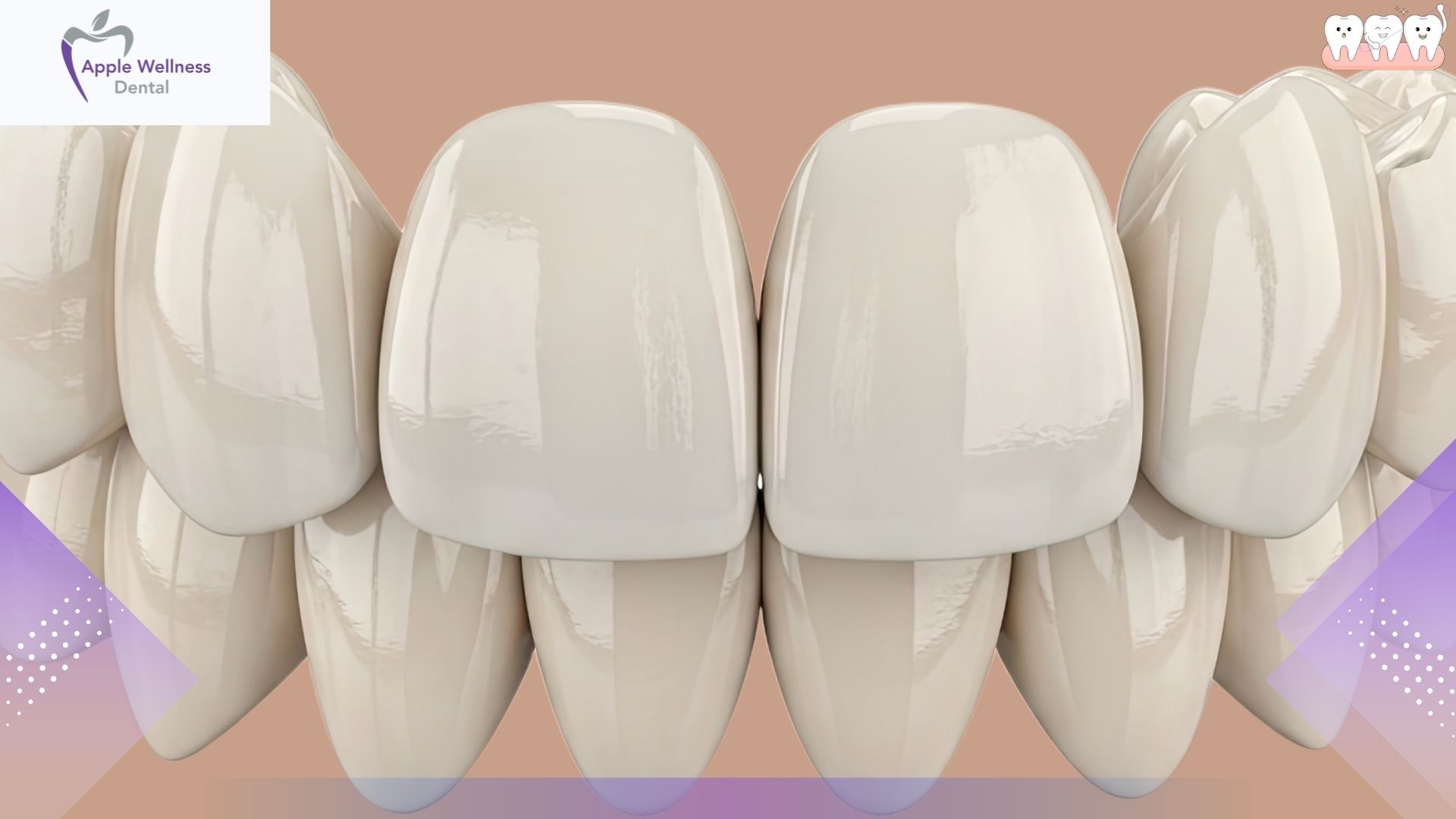 The Complete 2026 Guide to Pop-On Veneers: Costs, Benefits, and Alternatives - Apple Wellness Dental The Complete 2026 Guide to Pop-On Veneers: Costs, Benefits, and Alternatives - Apple Wellness Dental